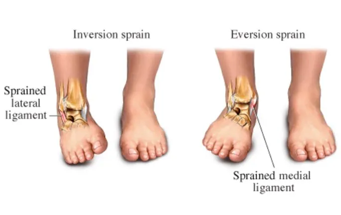 Advanced Ligament Injury Treatment in Nashik by Dr...