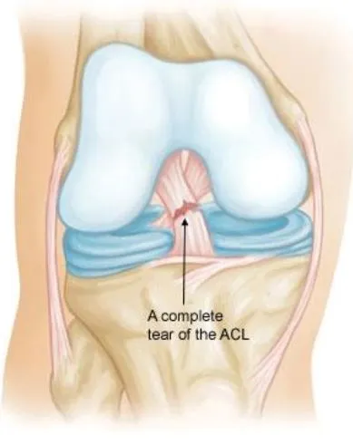 Expert Ligament Tear Treatment in Nashik by Dr. Ra...