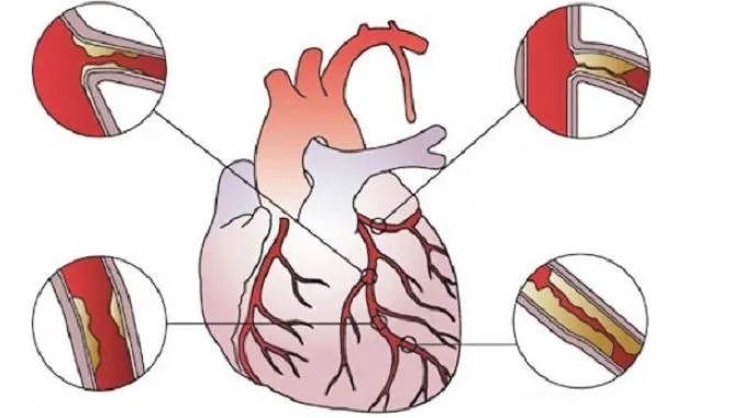 Effective Treatment for Heart Blockages at SR Hear...