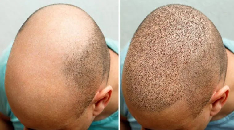 Premier Hair Transplant Services at Gindodia Hospi...
