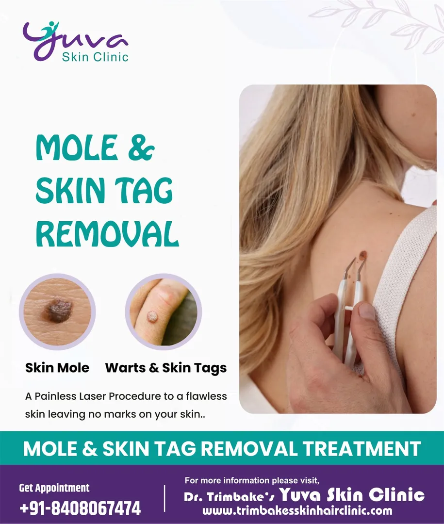 Mole removal and skin tag removal treatment is all...