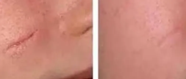 Scar Treatment Services | Kimaya Skin Clinic, Pune...