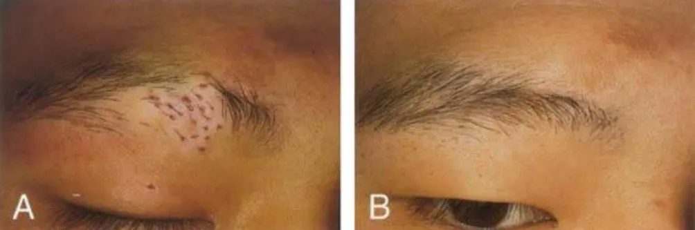 Specialized Hair Transplant for Vitiligo at Gindod...