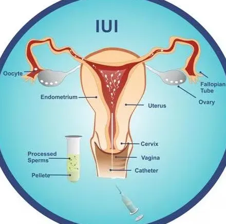 IUI Treatment in Thane Best IUI Treatment in Thane...