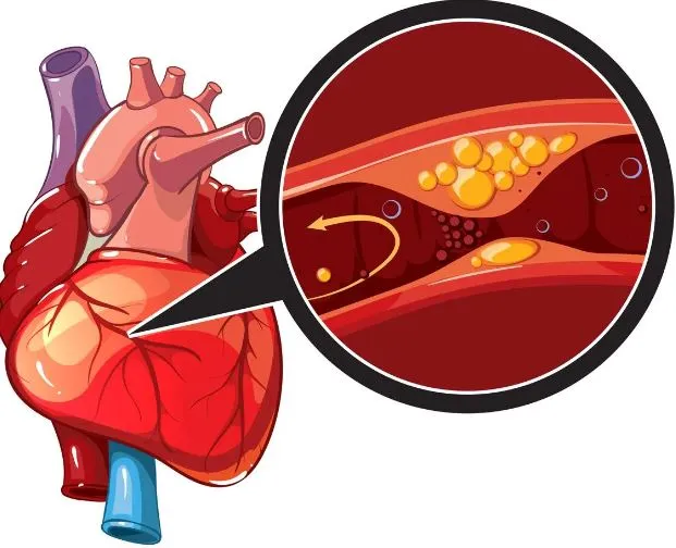 Expert Care for Coronary Artery Disease at SR Hear...