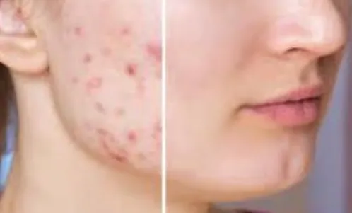 Pimples Treatment at Kimaya Skin Clinic, Pune Effe...