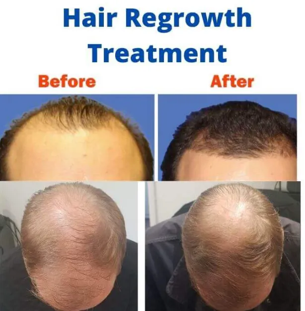 Best Hair Regrowth Treatment and Effective Solutio...