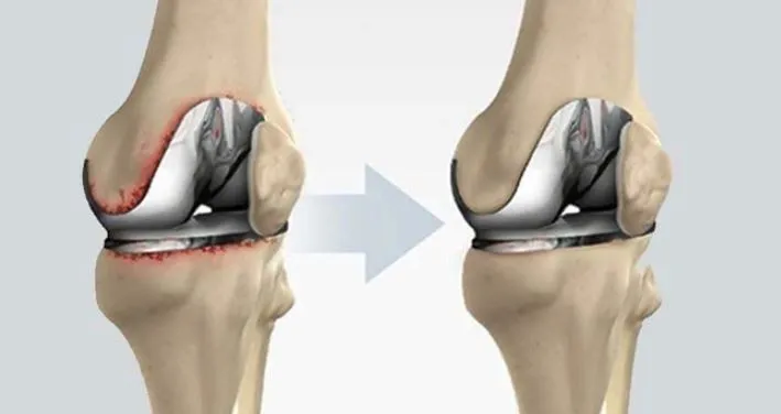 Trusted Revision Joint Replacement Surgery in Nash...