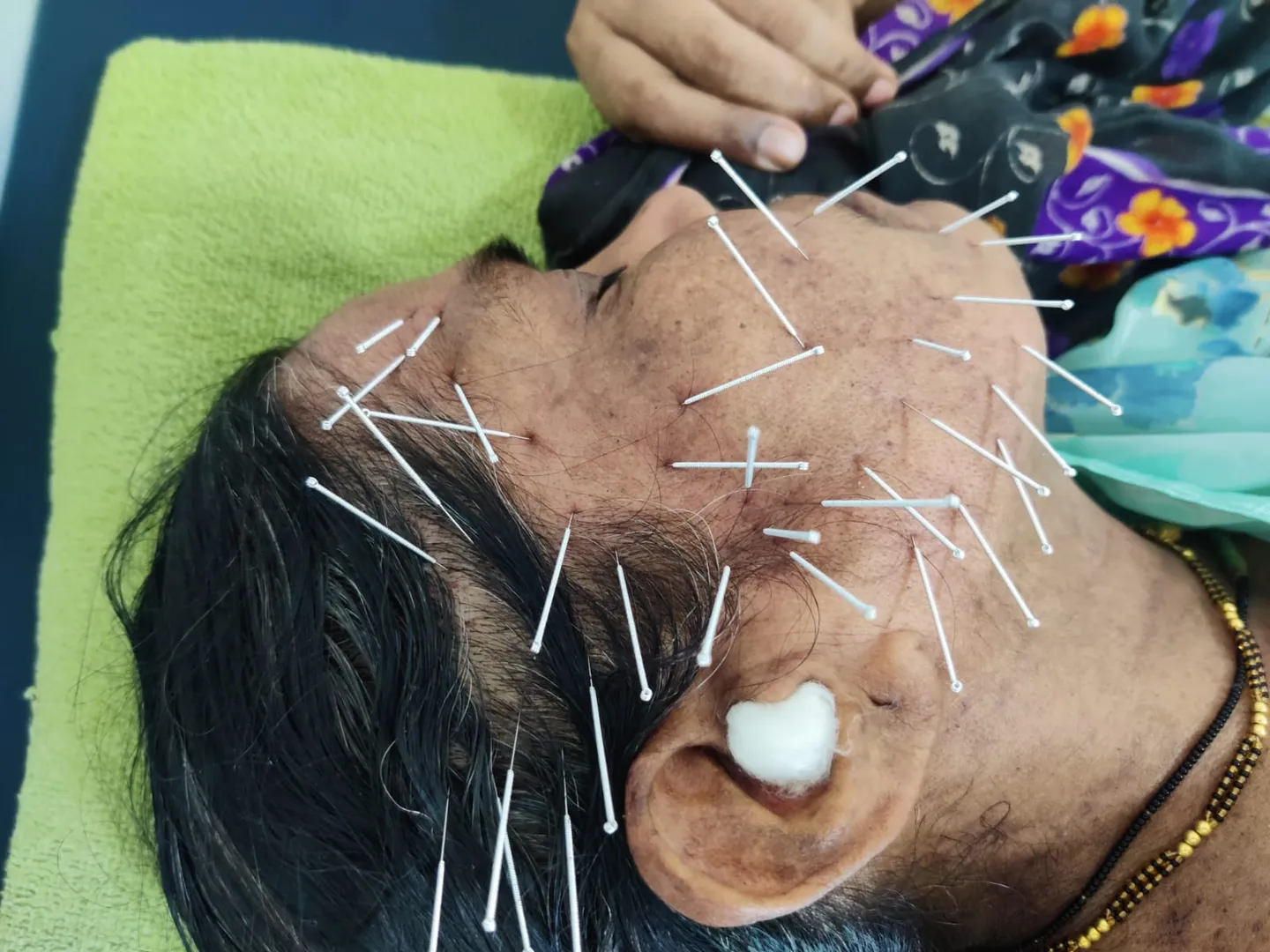 Novel Treatment for Trigeminal Neuralgia: Ultrasou...