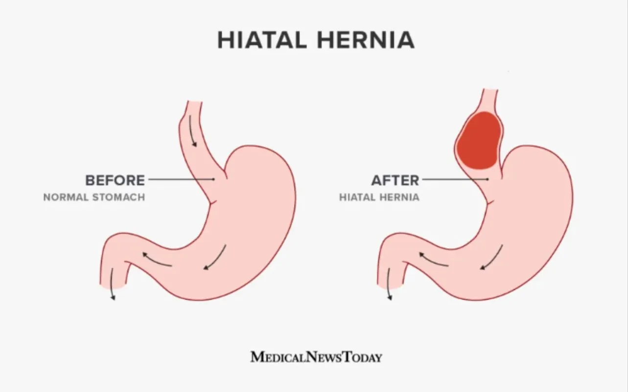 Best Hiatus Hernia Surgery in Nagpur For those suf...