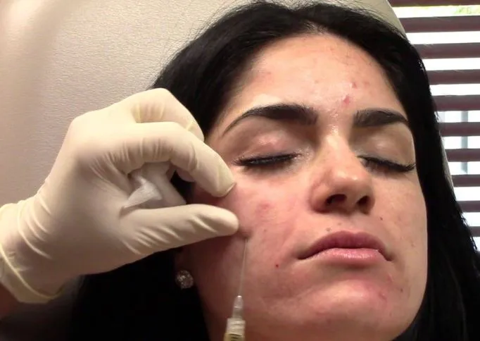 Effective PRP Therapy for Acne at Gindodia Hospita...