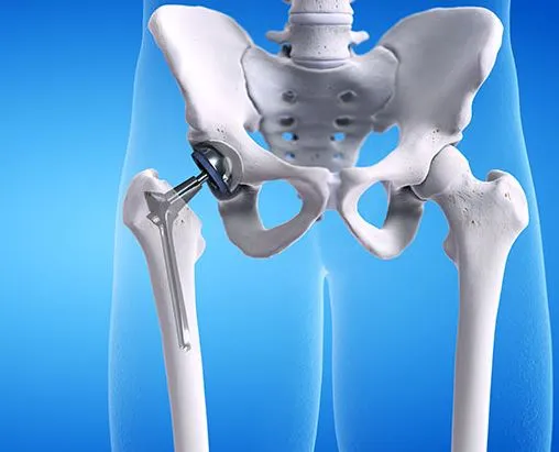 Top Hip Replacement Surgery in Nashik by Dr. Rakes...