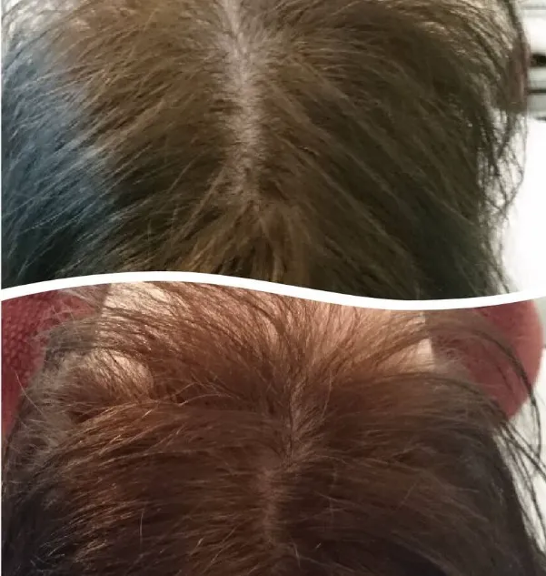 Top Hair Rejuvenation Treatment in Pune Restore ou...