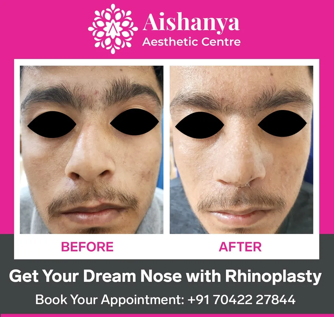 Rhinoplasty in West Delhi
We take a personalized ...