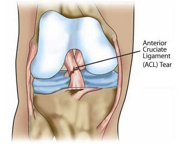 Effective Treatment Options for ACL Tears ACL (Ant...