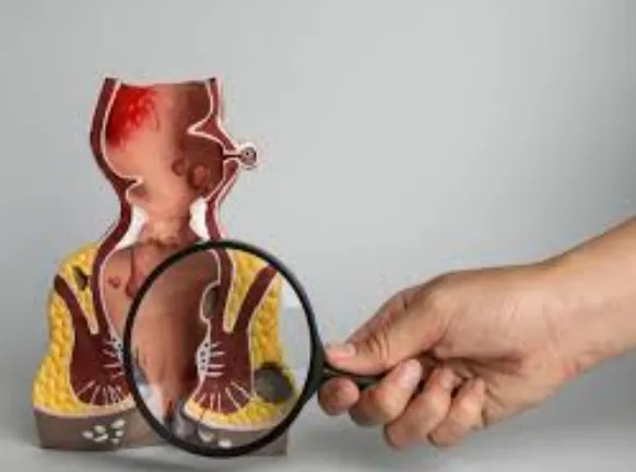 Best Fistula Doctor in Kalyan West Comprehensive C...