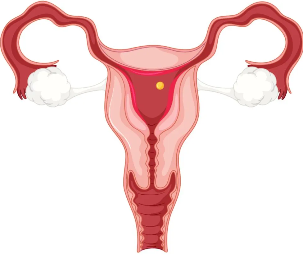 Hysterectomy Treatment in Thane Expert Hysterectom...