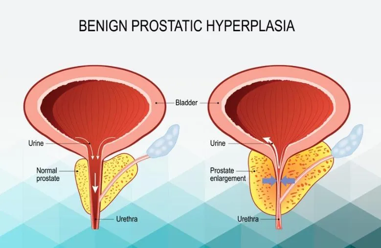 Understanding Benign Prostatic Hypertrophy: Sympto...