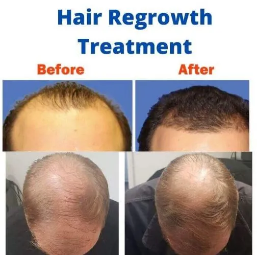Boost Hair Growth with Hair Regrowth Treatment in ...