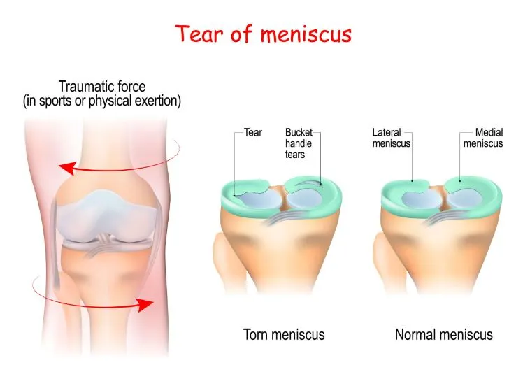 Medial Meniscus Tears: Symptoms and Treatments A m...