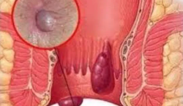 Best Anal Fissure Doctor in Kalyan East – Superior...
