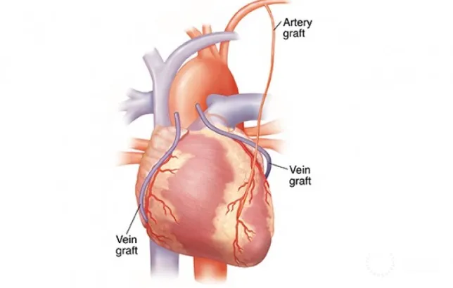 OPCAB in Nagpur: Off-Pump Coronary Artery Bypass f...