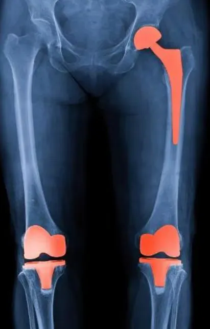 Knee and Hip Replacement in Pimpri-Chinchwad If yo...