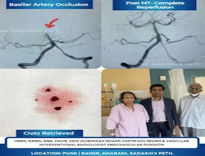 Brain stroke is completely curable...it requires e...