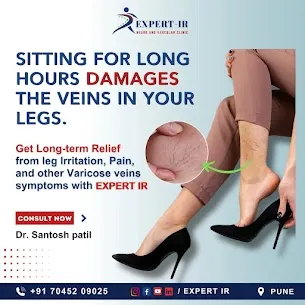 Varicose veins develop for many reasons. A sedenta...