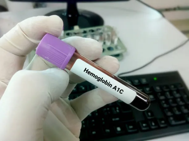 Abnormal Hemoglobin: The Role of Hb Electrophoresi...