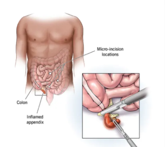 Appendix Surgery in Nagpur Appendicitis occurs whe...