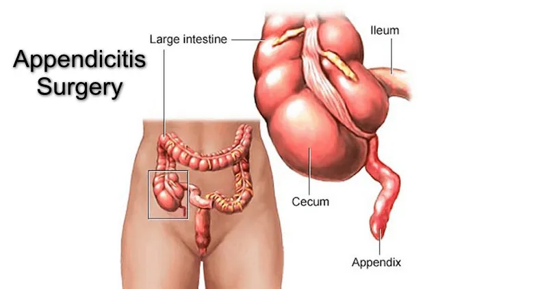 Appendix Removal in Nagpur The appendix, though of...
