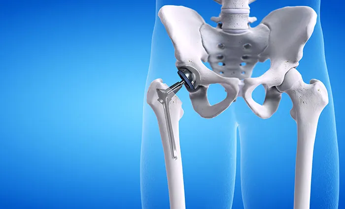 Hip Replacement Surgeon Bangalore Dr. Raghavendra ...