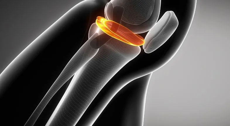 Specialized care for lateral Meniscus Tears in Nas...