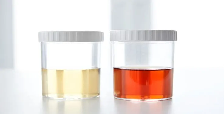 Addressing Blood in Urine: When Should You See a S...