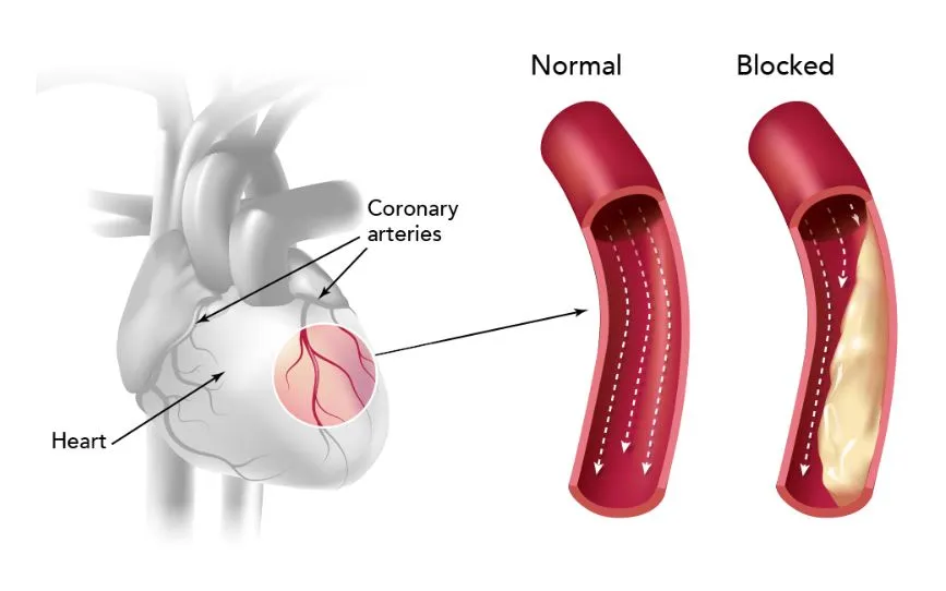 How Coronary Artery Blockage Impacts Your Heart He...
