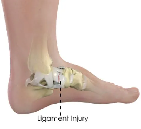 Comprehensive Care for Ligament Injuries in Nashik...