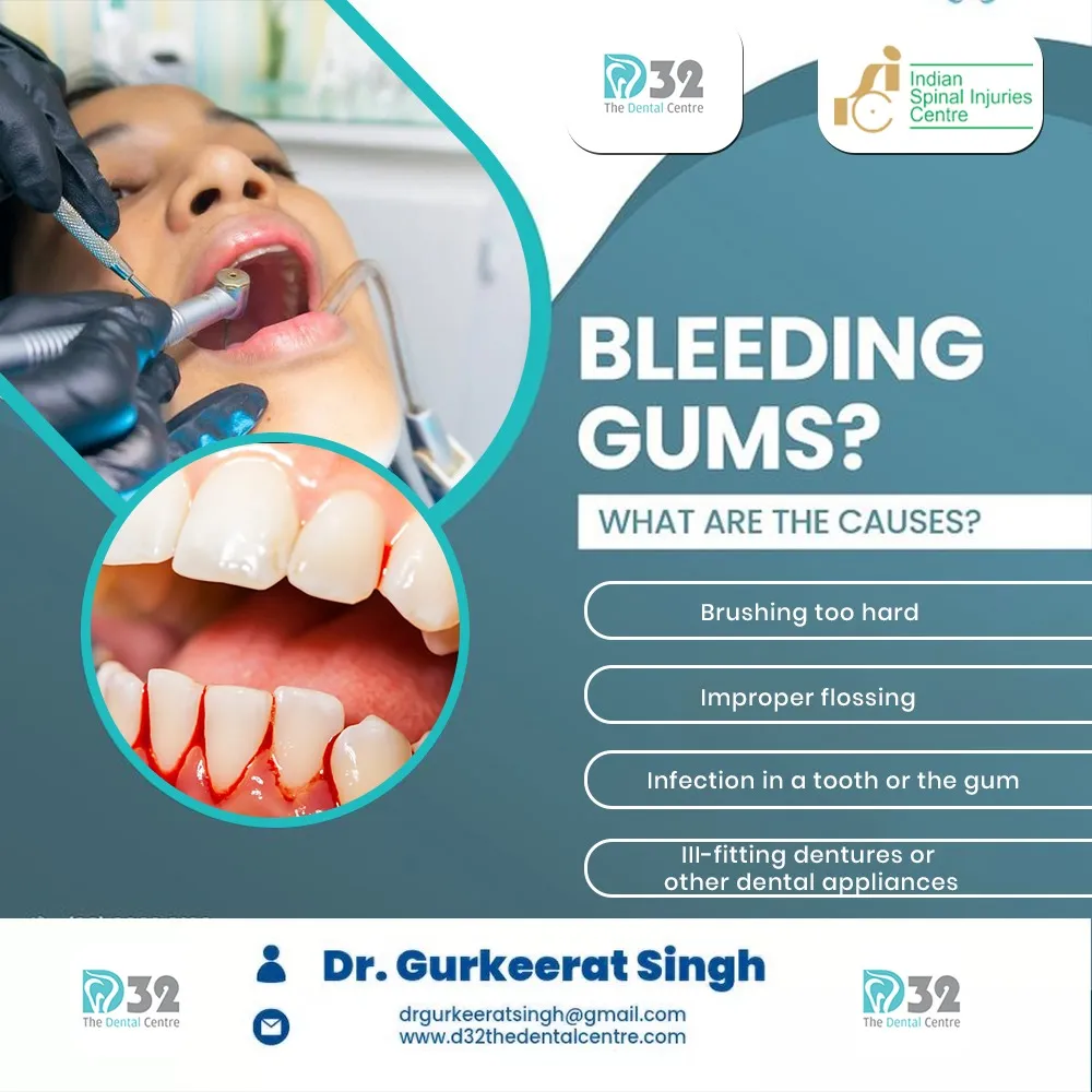 Bleeding gums treatment in South Delhi
D32 The De...