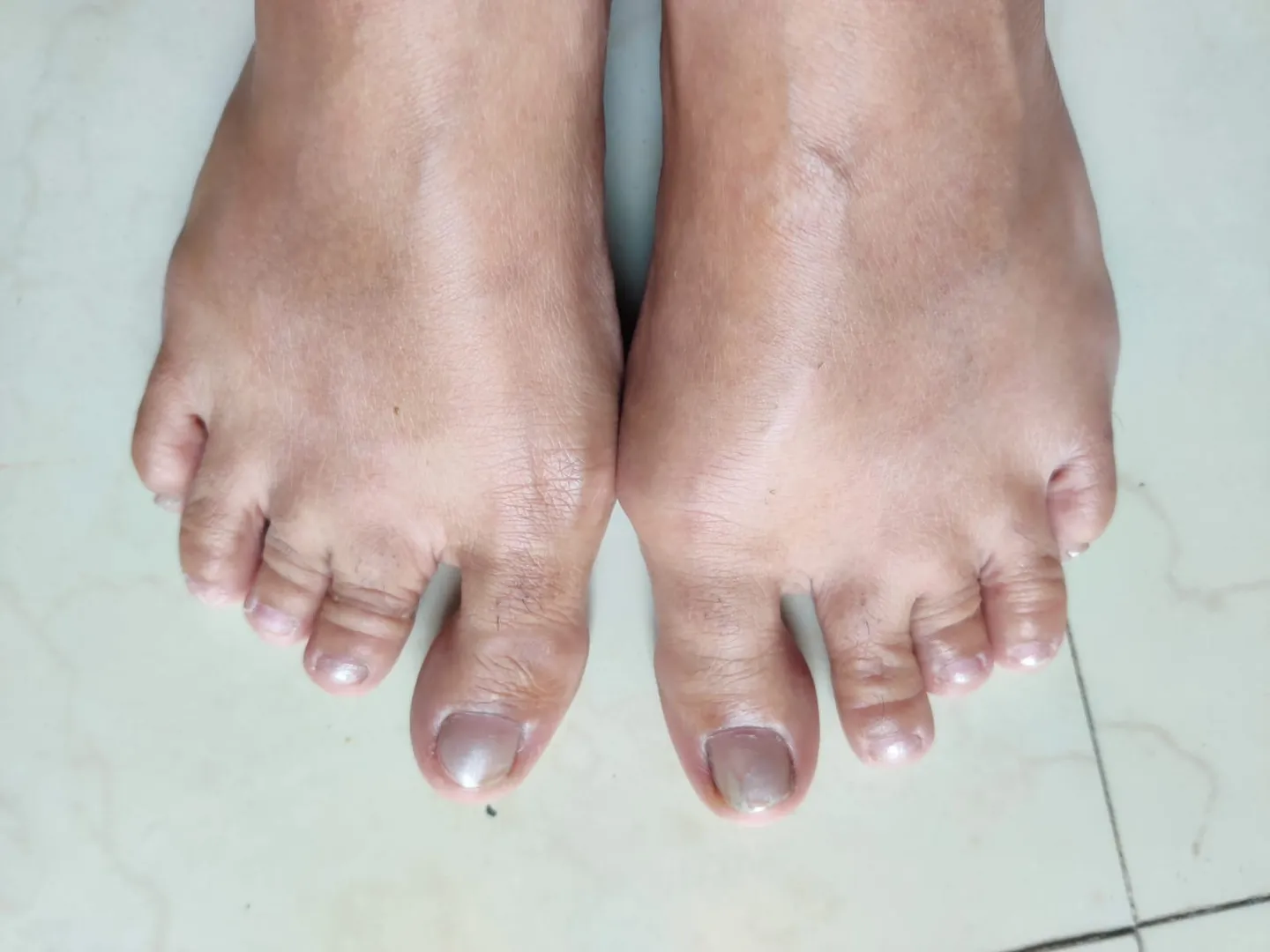 Post-Chikungunya Joint Pain
Chikungunya is a vira...