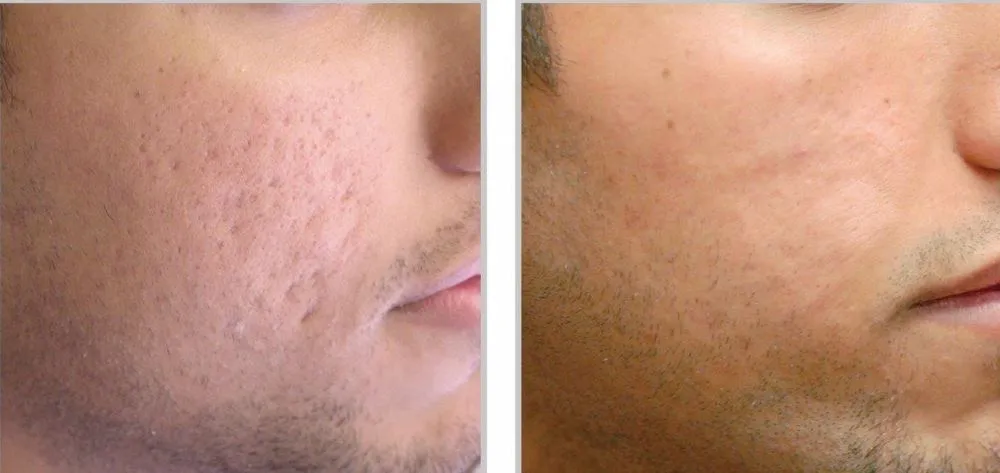 PRP Therapy for Acne at Gindodia Hospital: Effecti...