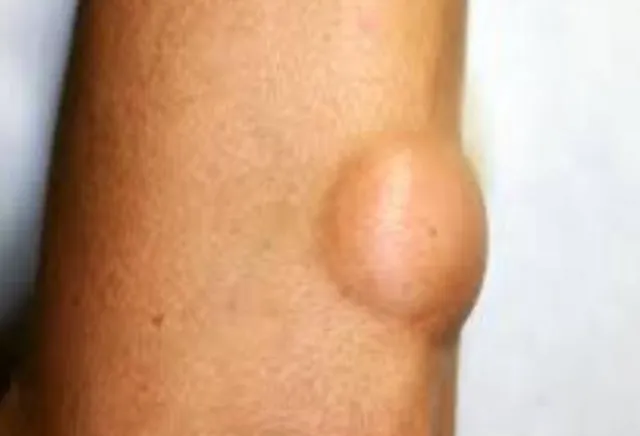 Best Lipoma Removal Doctor at Kalyan Lipomas, thou...