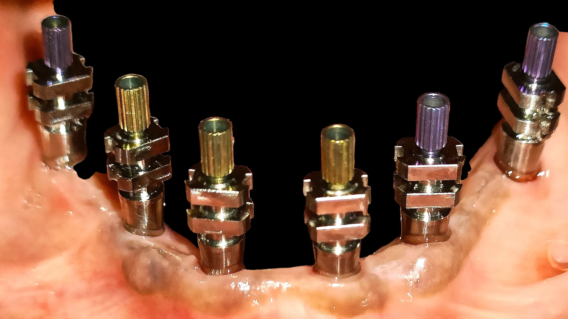 What makes Guided Implant Surgery, the best dental...