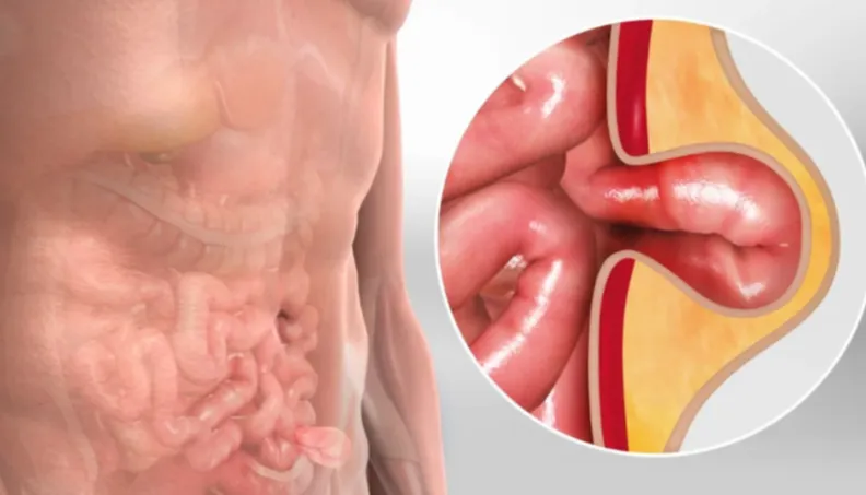 Best Hernia Doctor in Kalyan East Hernias can caus...