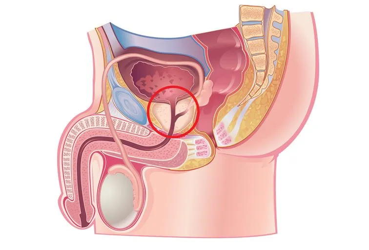 Understanding Prostate Surgery in Thane: What You ...
