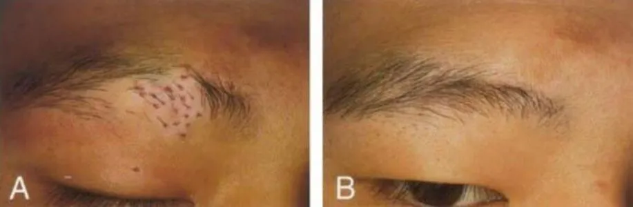 Hair Transplant for Vitiligo: Restore Confidence w...