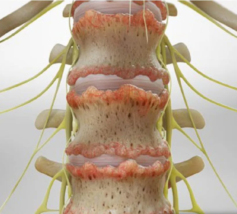 Ankylosing Spondylitis and Ayurvedic Panchakarma T...