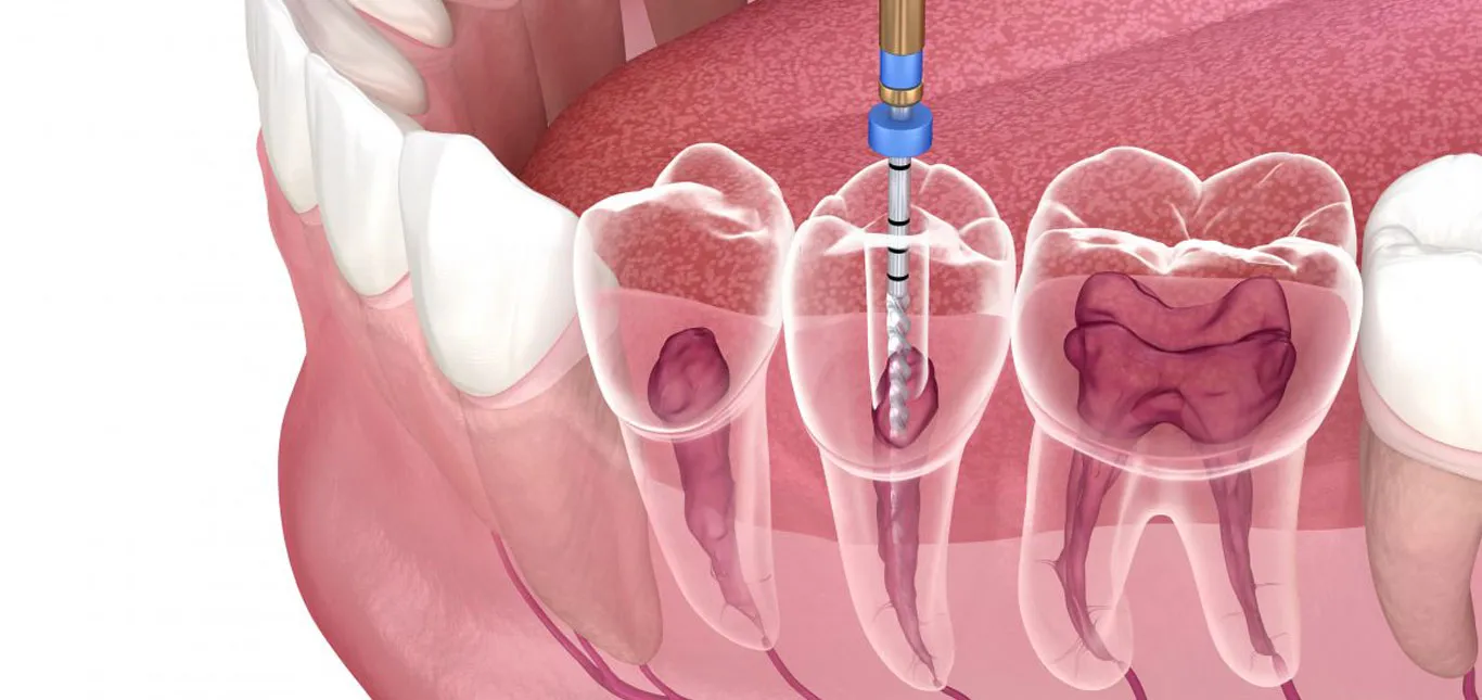 Root Canal Treatment in Anna Nagar – Professional ...