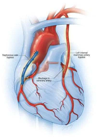 Best Beating Heart Bypass Surgery in Nagpur At Dr....