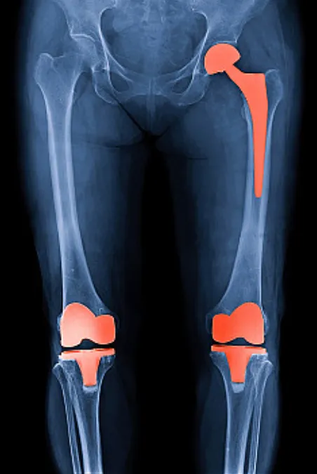 Reliable Knee and Hip Replacement at Anand Orthopa...