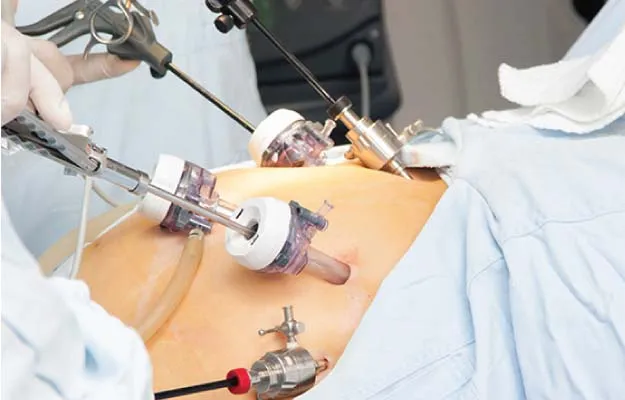 Understanding Laparoscopic Surgeries Laparoscopic ...